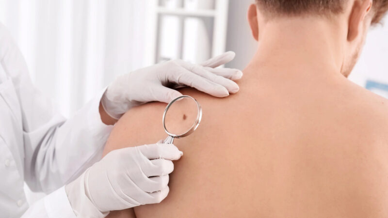 Why Annual Skin Checks Matter?