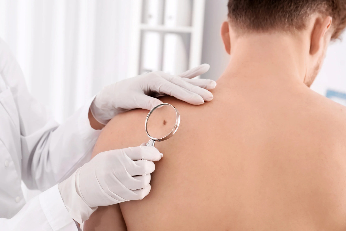 Why Annual Skin Checks Matter?